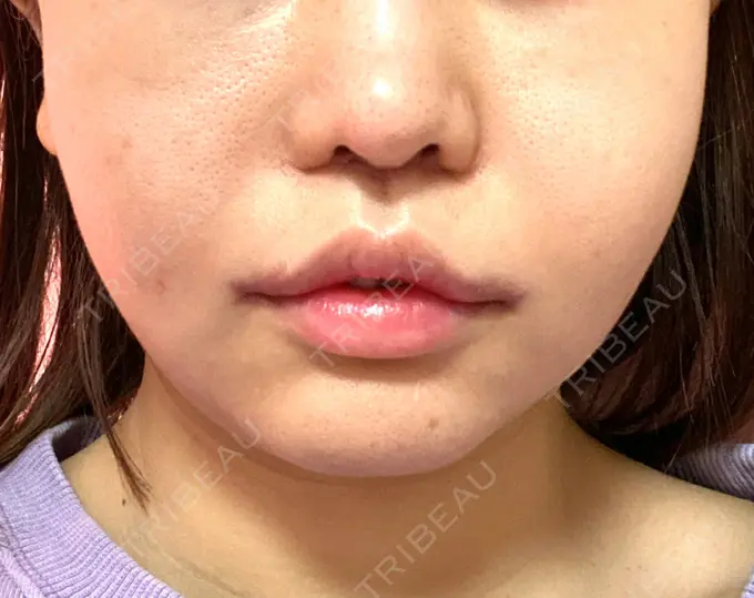 インディバ（お腹） / インディバ（二の腕） / インディバ（顔） / インディバ（腰） WOM SALON【術後ケア取扱いサロン】 AFTER メイン用