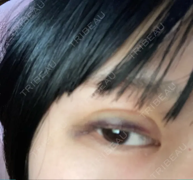 二重埋没 ルラ美容クリニック 名古屋本院 DAY 3 メイン用