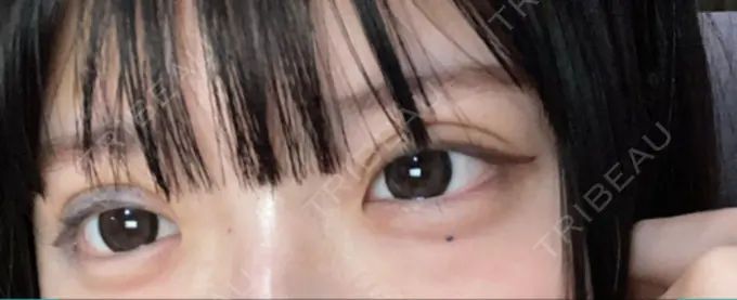 二重埋没 ルラ美容クリニック 名古屋本院 DAY 4 メイン用