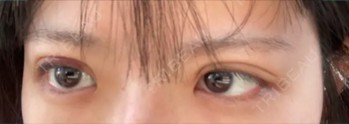 二重埋没 ルラ美容クリニック 名古屋本院 DAY 9 メイン用