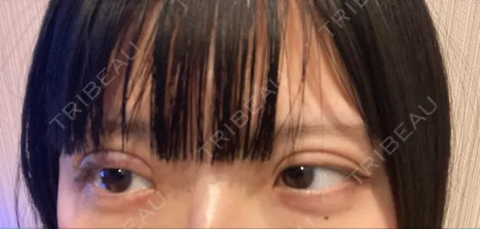 二重埋没 ルラ美容クリニック 名古屋本院 DAY 1 メイン用