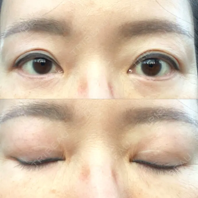 二重切開 / 眼瞼下垂（切開） / 下まぶたたるみ取り / 眉下切開 e:Top clinic（イートップクリニック） DAY 228 メイン用