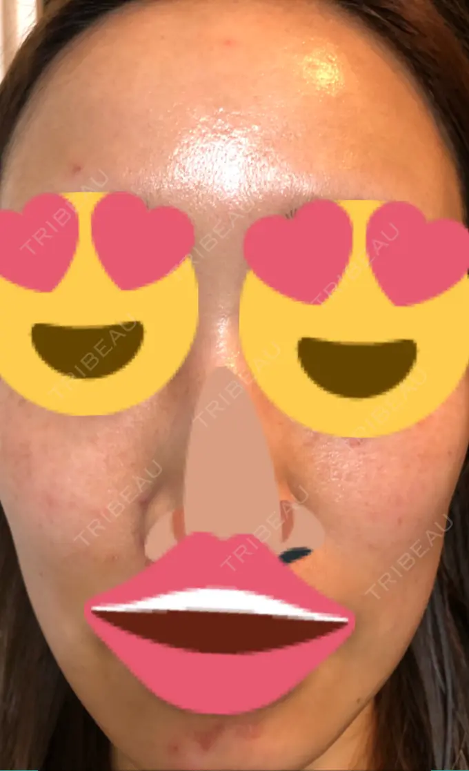 ニキビ治療 KM新宿クリニック DAY 2 メイン用