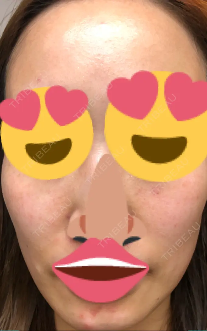 ニキビ治療 KM新宿クリニック DAY 3 メイン用