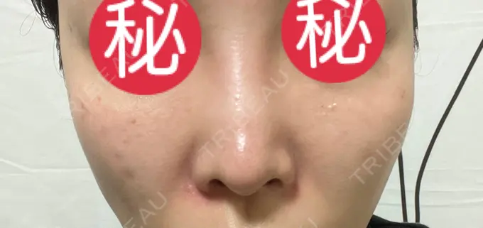 ピコレーザートーニング（美白・肝斑） / ピコスポット HAAB BEAUTY CLINIC 横浜院 DAY 8 メイン用