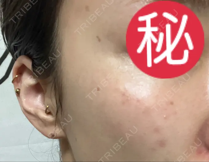 ピコレーザートーニング（美白・肝斑） / ピコスポット HAAB BEAUTY CLINIC 横浜院 DAY 8 メイン用