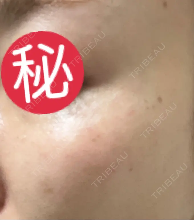 ピコレーザートーニング（美白・肝斑） / ピコスポット HAAB BEAUTY CLINIC 横浜院 DAY 8 メイン用