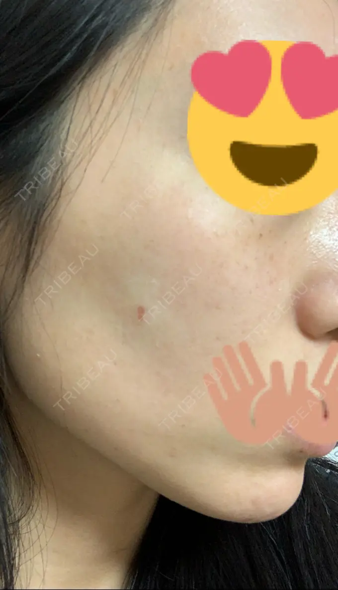 ほくろ・いぼ切除（肌） / 高濃度ビタミンC点滴 TCB東京中央美容外科 広島院 DAY 4 メイン用