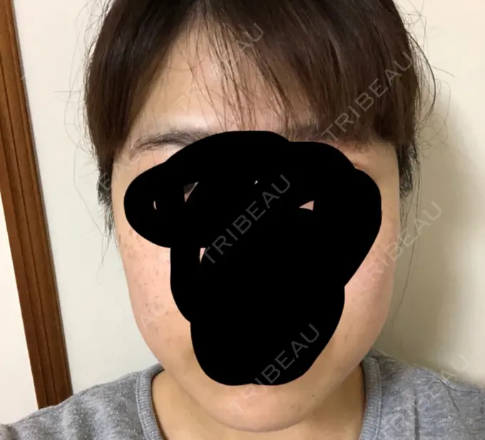 ボトックス（エラ・小顔） 湘南美容クリニック 名古屋栄院 DAY 3 メイン用