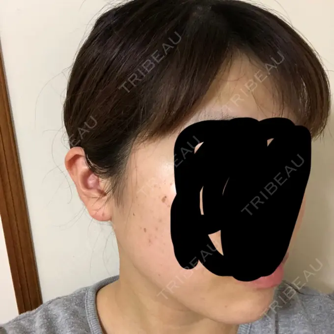 ボトックス（エラ・小顔） 湘南美容クリニック 名古屋栄院 DAY 3 メイン用