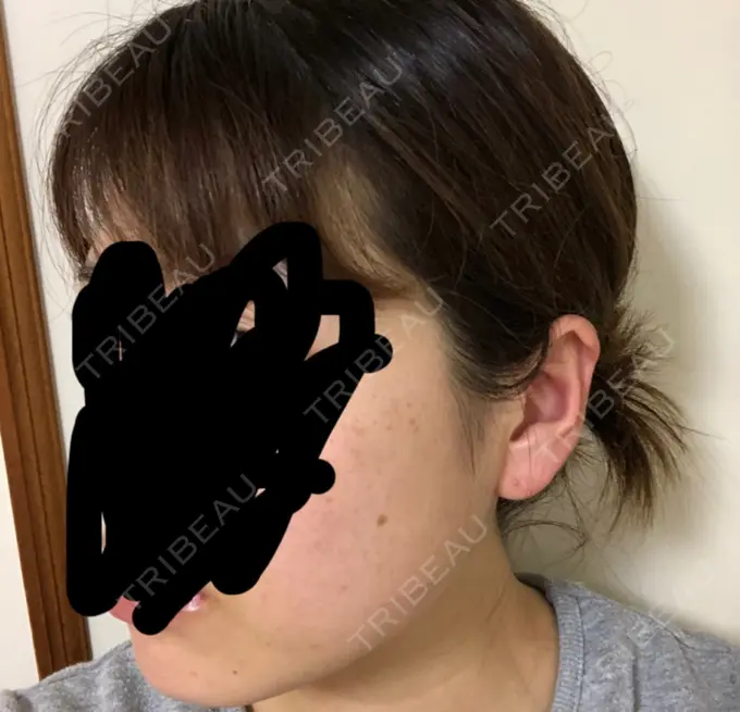 ボトックス（エラ・小顔） 湘南美容クリニック 名古屋栄院 DAY 3 メイン用