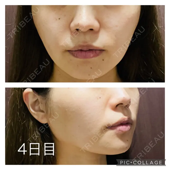 糸リフト アリエル美容クリニック 郡山院 DAY 4 メイン用