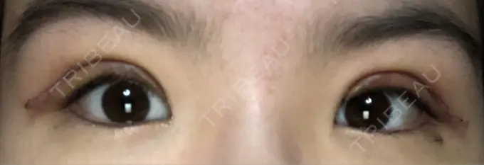 二重切開 / 上まぶたの脂肪取り ブリスクリニック形成外科・美容外科・美容皮膚科 福岡 AFTER メイン用