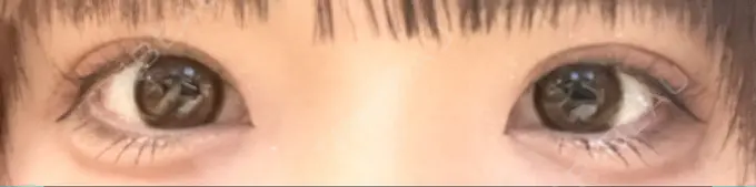 二重埋没 ハナビューティークリニック AFTER メイン用