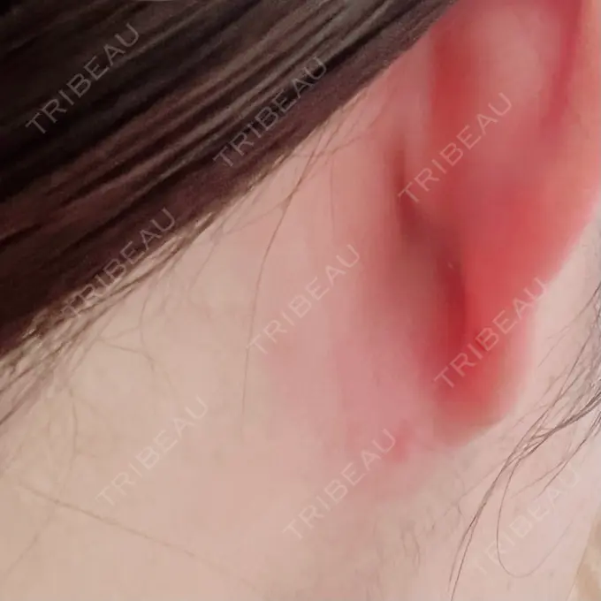 脂肪吸引（顔） THE CLINIC（ザ・クリニック） 福岡院 DAY 81 メイン用