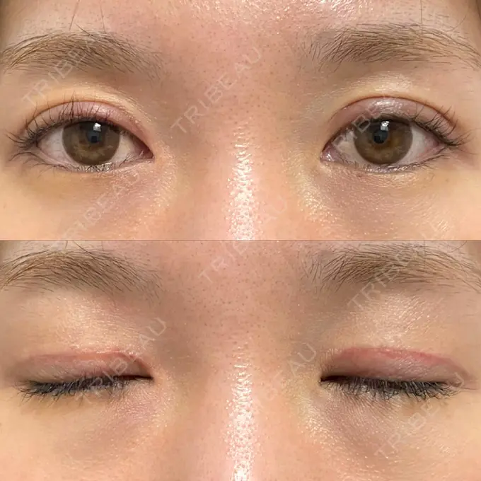 二重切開 / 上まぶたたるみ取り みずほクリニック DAY 28 メイン用