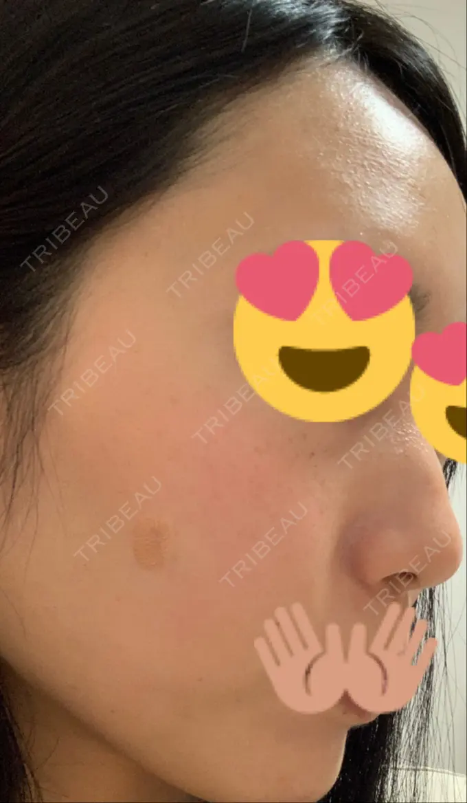 ほくろ・いぼ切除（肌） / 高濃度ビタミンC点滴 TCB東京中央美容外科 広島院 DAY 6 メイン用