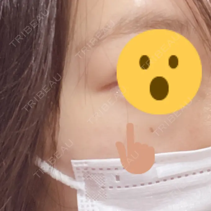 ピコスポット LOUIS CLINIC 二子玉川院【ルイクリニック】 AFTER メイン用