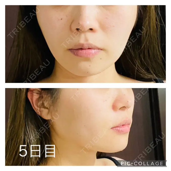 糸リフト アリエル美容クリニック 郡山院 DAY 5 メイン用