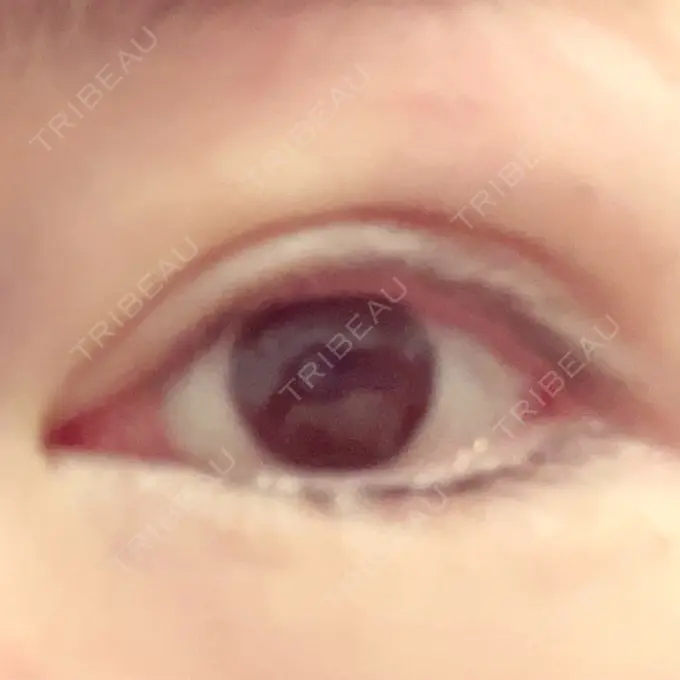 小鼻縮小（切開） / 眼瞼下垂（非切開） SOL CLINIC DAY 0 メイン用