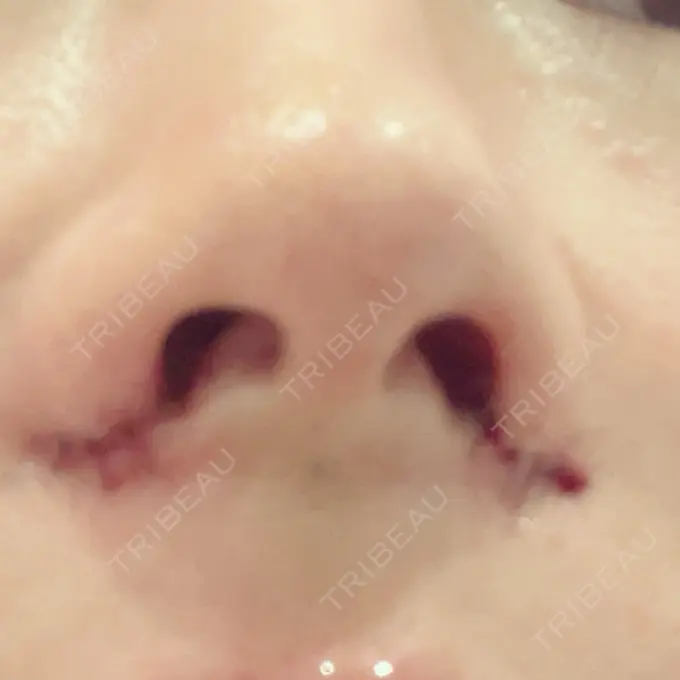 小鼻縮小（切開） / 眼瞼下垂（非切開） SOL CLINIC DAY 0 メイン用