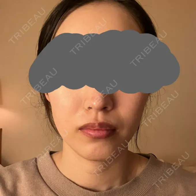 脂肪溶解注射（顔） SK新宿歌舞伎町美容外科・歯科 DAY 10 メイン用