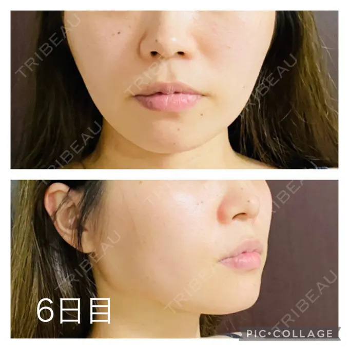 糸リフト アリエル美容クリニック 郡山院 DAY 6 メイン用