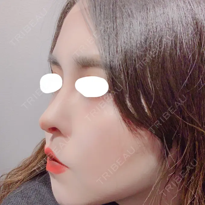 鼻中隔延長（切開） みずほクリニック DAY 7 メイン用