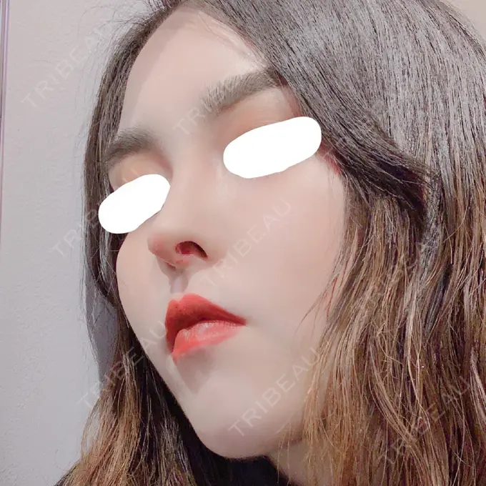 鼻中隔延長（切開） みずほクリニック DAY 7 メイン用