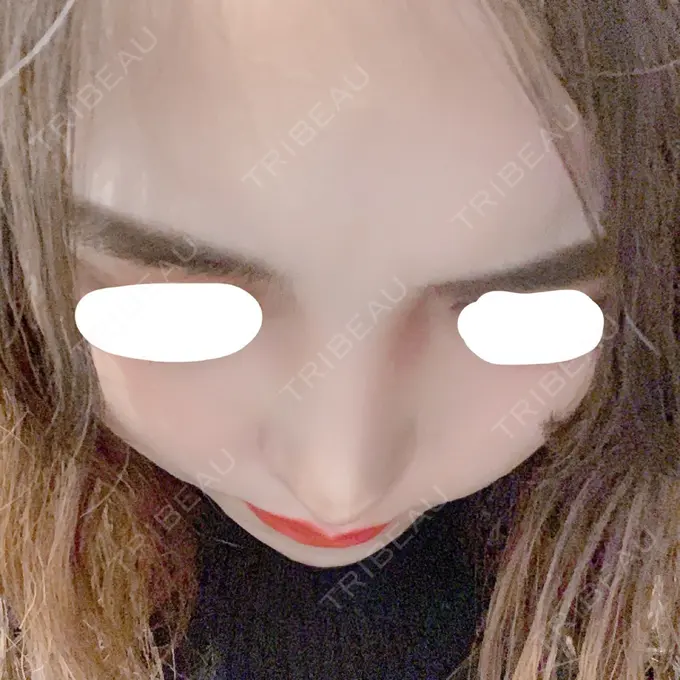 鼻中隔延長（切開） みずほクリニック DAY 7 メイン用