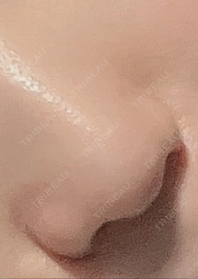 小鼻縮小（切開） 吉祥寺アイビークリニック DAY 10 メイン用