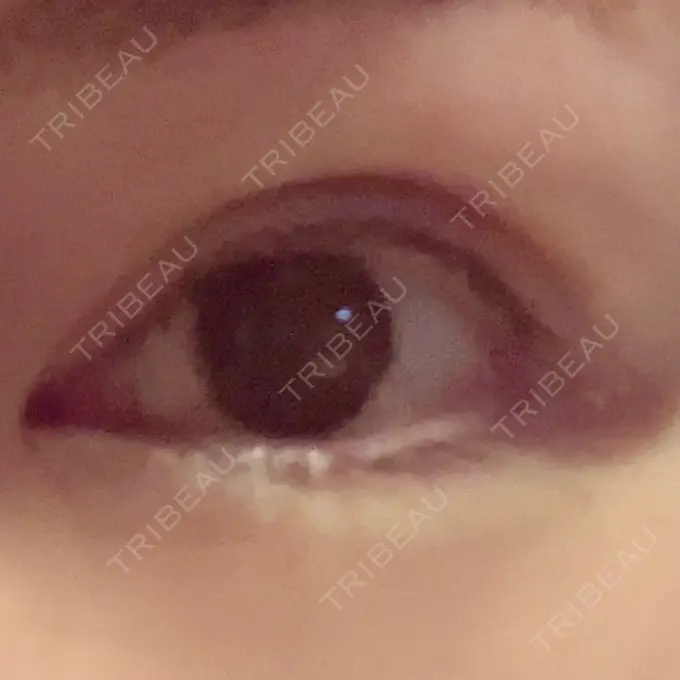 小鼻縮小（切開） / 眼瞼下垂（非切開） SOL CLINIC DAY 1 メイン用