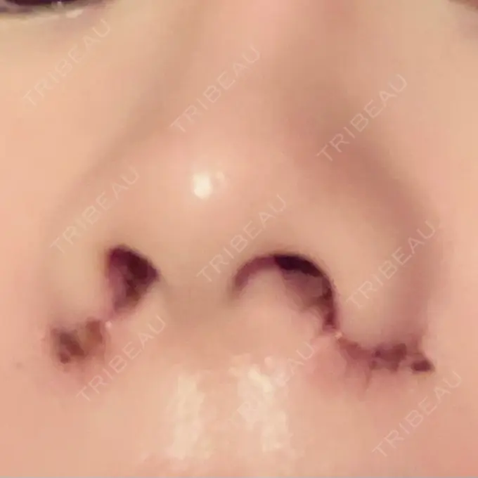 小鼻縮小（切開） / 眼瞼下垂（非切開） SOL CLINIC DAY 1 メイン用