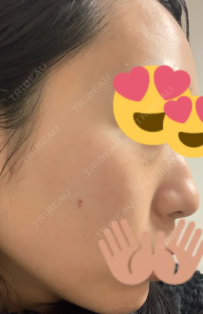 ほくろ・いぼ切除（肌） / 高濃度ビタミンC点滴 TCB東京中央美容外科 広島院 DAY 7 メイン用