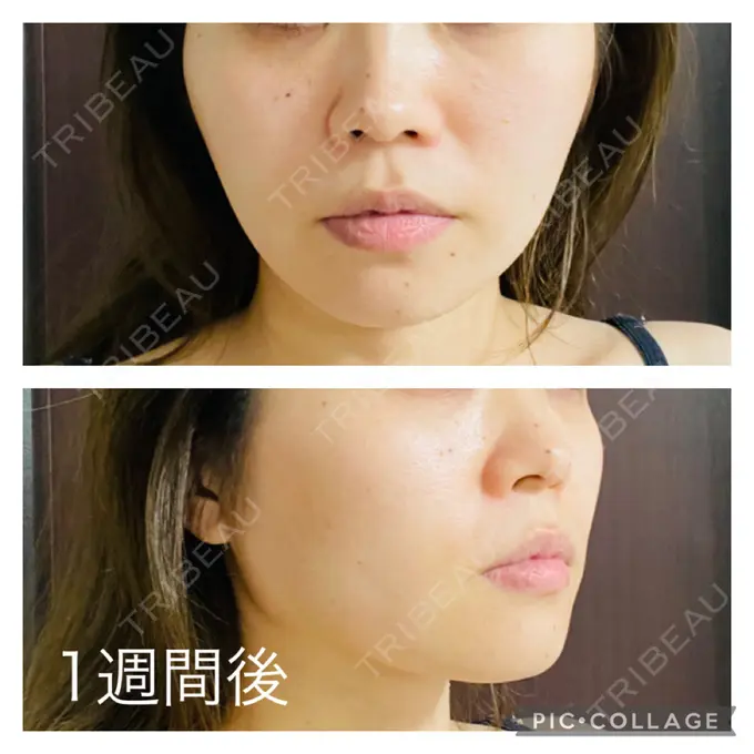 糸リフト アリエル美容クリニック 郡山院 DAY 7 メイン用