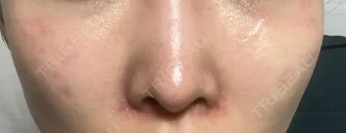 ピコレーザートーニング（美白・肝斑） / ピコスポット HAAB BEAUTY CLINIC 横浜院 DAY 11 メイン用