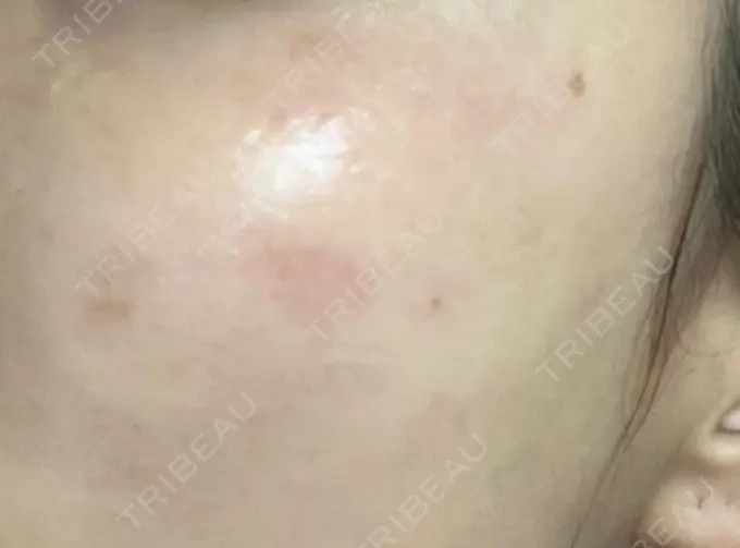 ピコレーザートーニング（美白・肝斑） / ピコスポット HAAB BEAUTY CLINIC 横浜院 DAY 11 メイン用