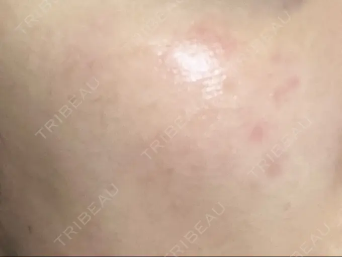 ピコレーザートーニング（美白・肝斑） / ピコスポット HAAB BEAUTY CLINIC 横浜院 DAY 11 メイン用