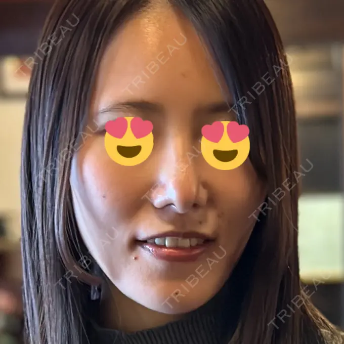 軟骨移植 / 骨切幅寄せ / ワシ鼻修正・ハンプ切除 / 鼻尖形成（非切開） 銀座マイアミ美容外科 DAY 35 メイン用