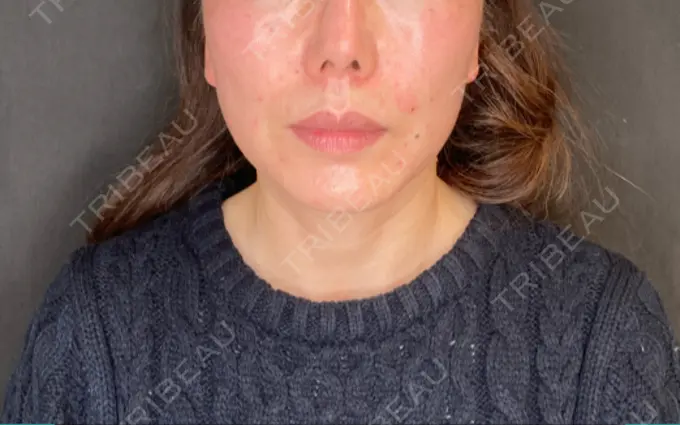 肌ヒアルロン酸注入（たるみ・シワ改善） / ボトックス（口角） / ボトックス（ガミースマイル） veary clinic AFTER メイン用