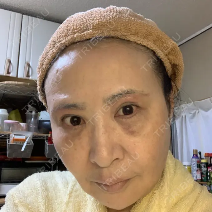 糸リフト / 下まぶたの脂肪取り / 脂肪注入（輪郭） / その他（目元） 湘南美容クリニック 橋本院 DAY 29 メイン用