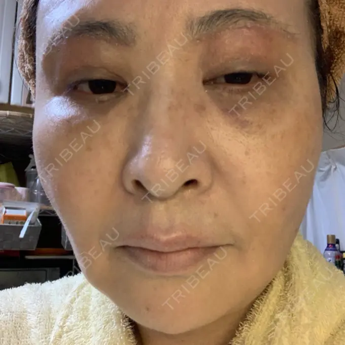 糸リフト / 下まぶたの脂肪取り / 脂肪注入（輪郭） / その他（目元） 湘南美容クリニック 橋本院 DAY 29 メイン用