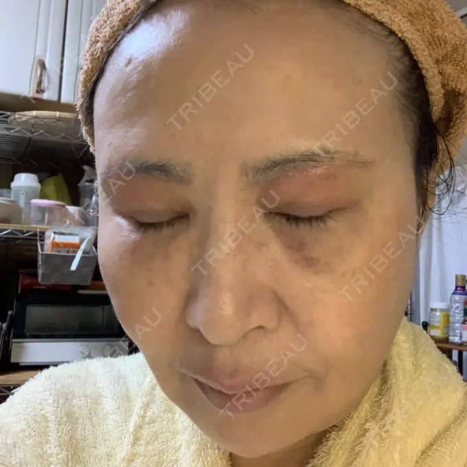 糸リフト / 下まぶたの脂肪取り / 脂肪注入（輪郭） / その他（目元） 湘南美容クリニック 橋本院 DAY 29 メイン用