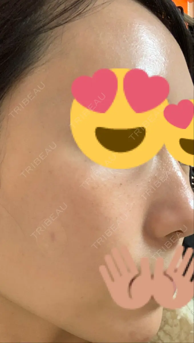 ほくろ・いぼ切除（肌） / 高濃度ビタミンC点滴 TCB東京中央美容外科 広島院 DAY 11 メイン用