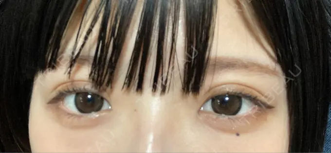 二重埋没 ルラ美容クリニック 名古屋本院 AFTER メイン用