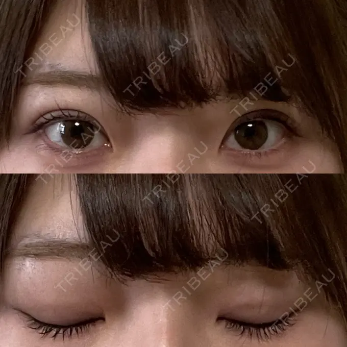 二重埋没 湘南美容クリニック 京都院 DAY 6 メイン用