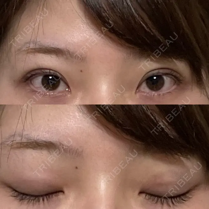 二重埋没 湘南美容クリニック 京都院 DAY 6 メイン用