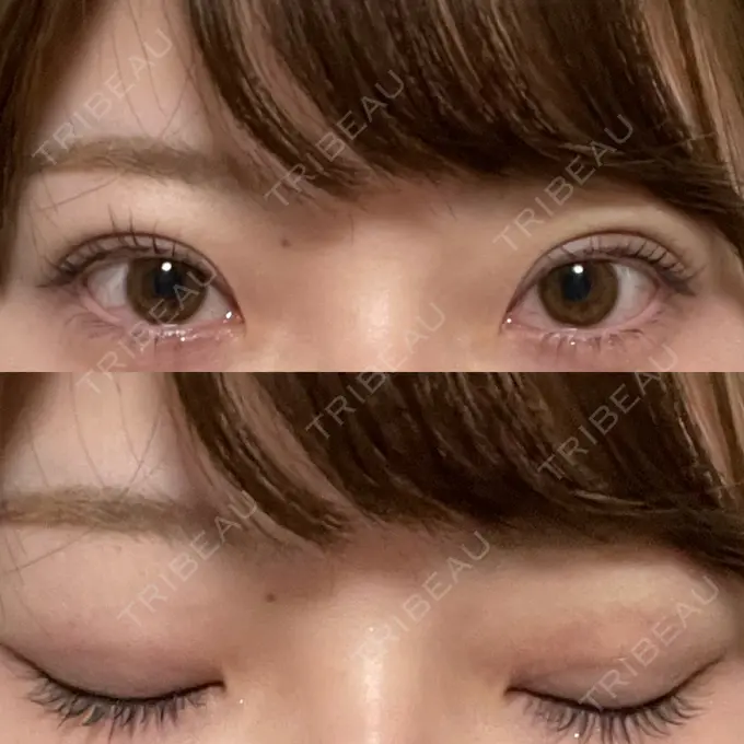 二重埋没 湘南美容クリニック 京都院 DAY 7 メイン用