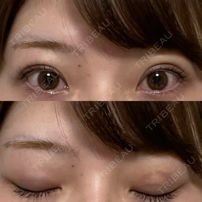 二重埋没 湘南美容クリニック 京都院 DAY 7 メイン用