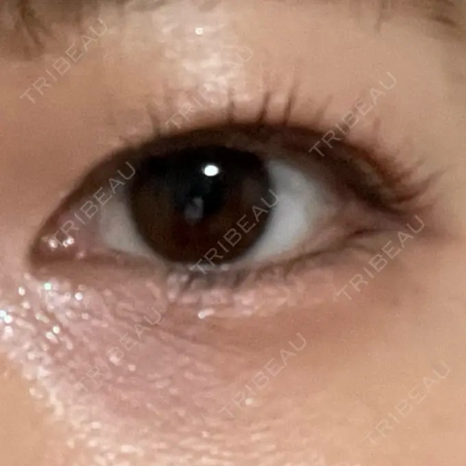 二重埋没 ネビュラクリニック 広島院 DAY 6 メイン用